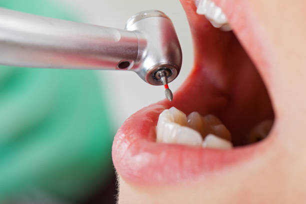 Best Chipped Tooth Repair Near Me  in Sunrise, FL